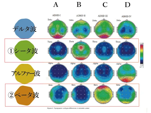 4つのグループに分類されるADHD